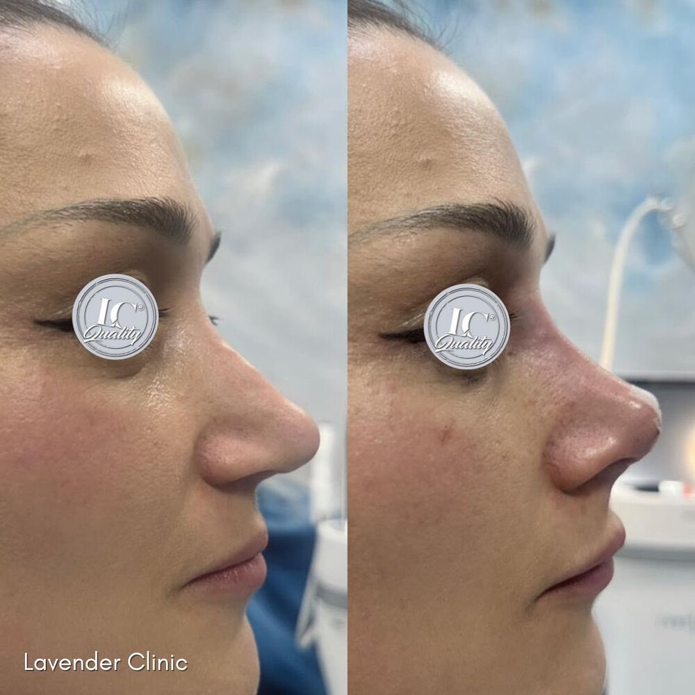 Before and After Result